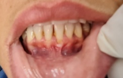 Freio labial inferior de com inserção alta, com duas inserções, causando maior perda óssea em apenas um dente.