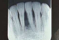 Radiografia mostrando a perda óssea causada pela ação do freio labial da foto anterior