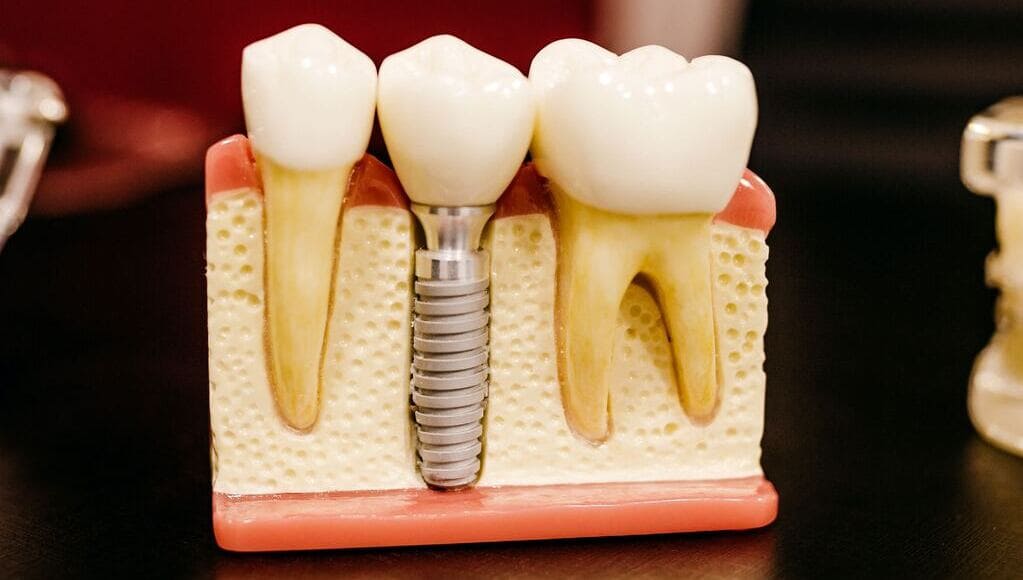 Detalhe do esquema do implaten entre dois dentes